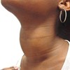 diffuse goiters pictures